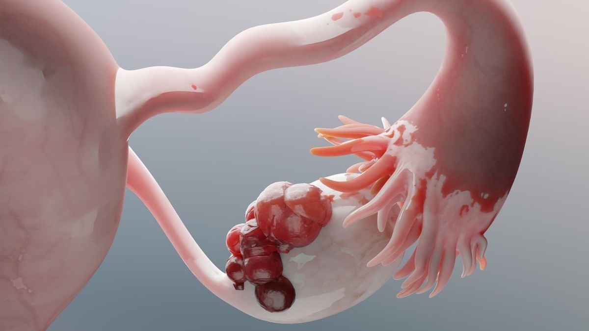 Premature Ovarian Insufficiency (POI)