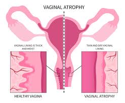 Vaginal Atrophy & Genitourinary Syndrome of Menopause